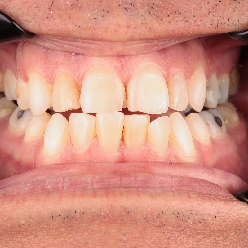 Before treatment — worn, yellowed teeth with old fillings
