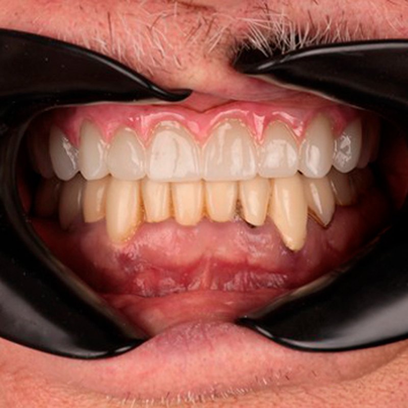 After treatment — full fixed restoration on implants