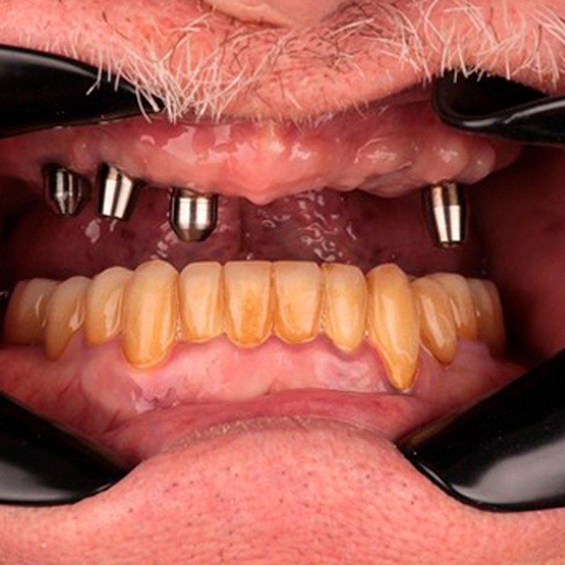 During treatment — dental implant abutments placed