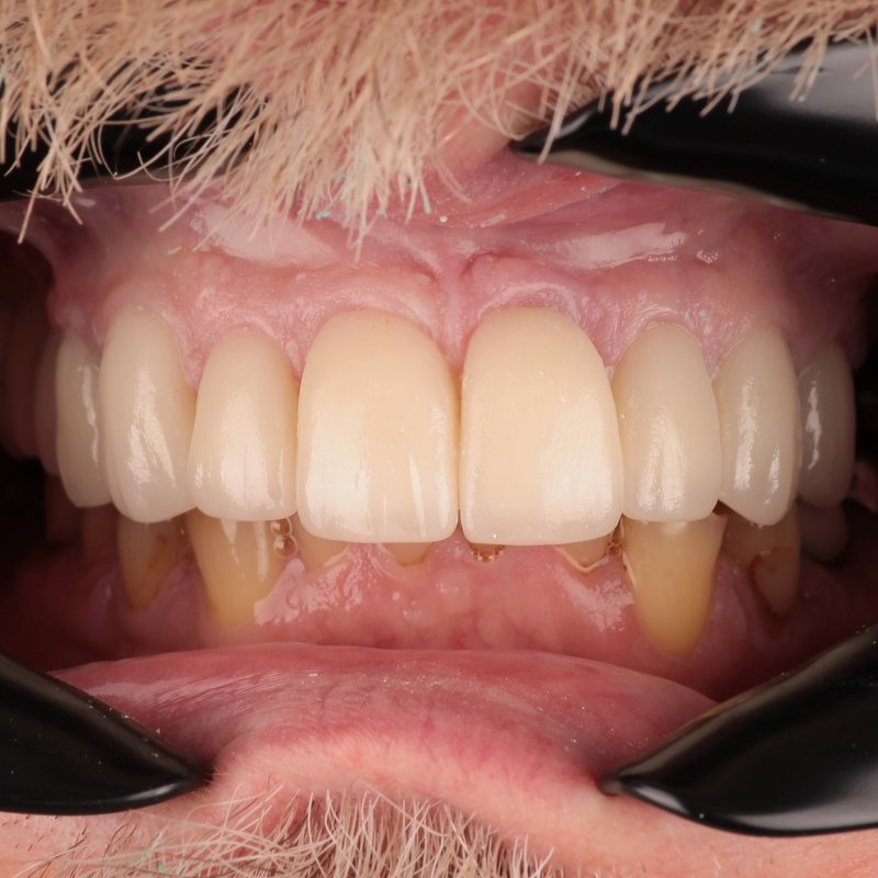 After treatment — custom zirconia crowns, natural shade